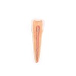 Unterkieferhälfte-Modell mit 8 kariösen Zähnen, 19-tlg - 3B Smart Anatomy