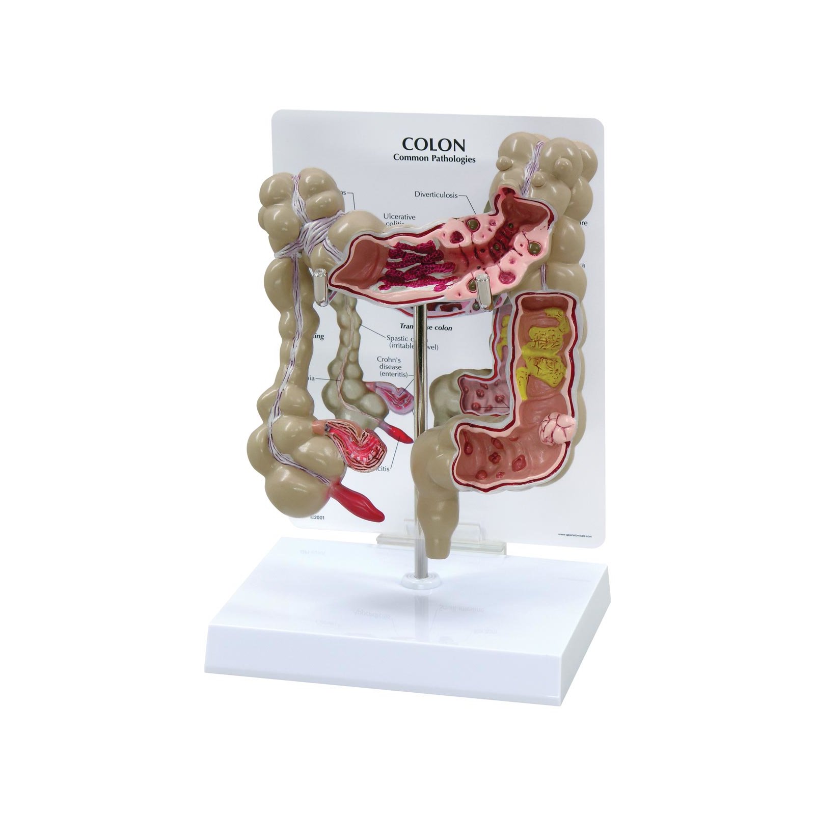 Colon Model With Common Pathologies 3340 Colon Anatomy