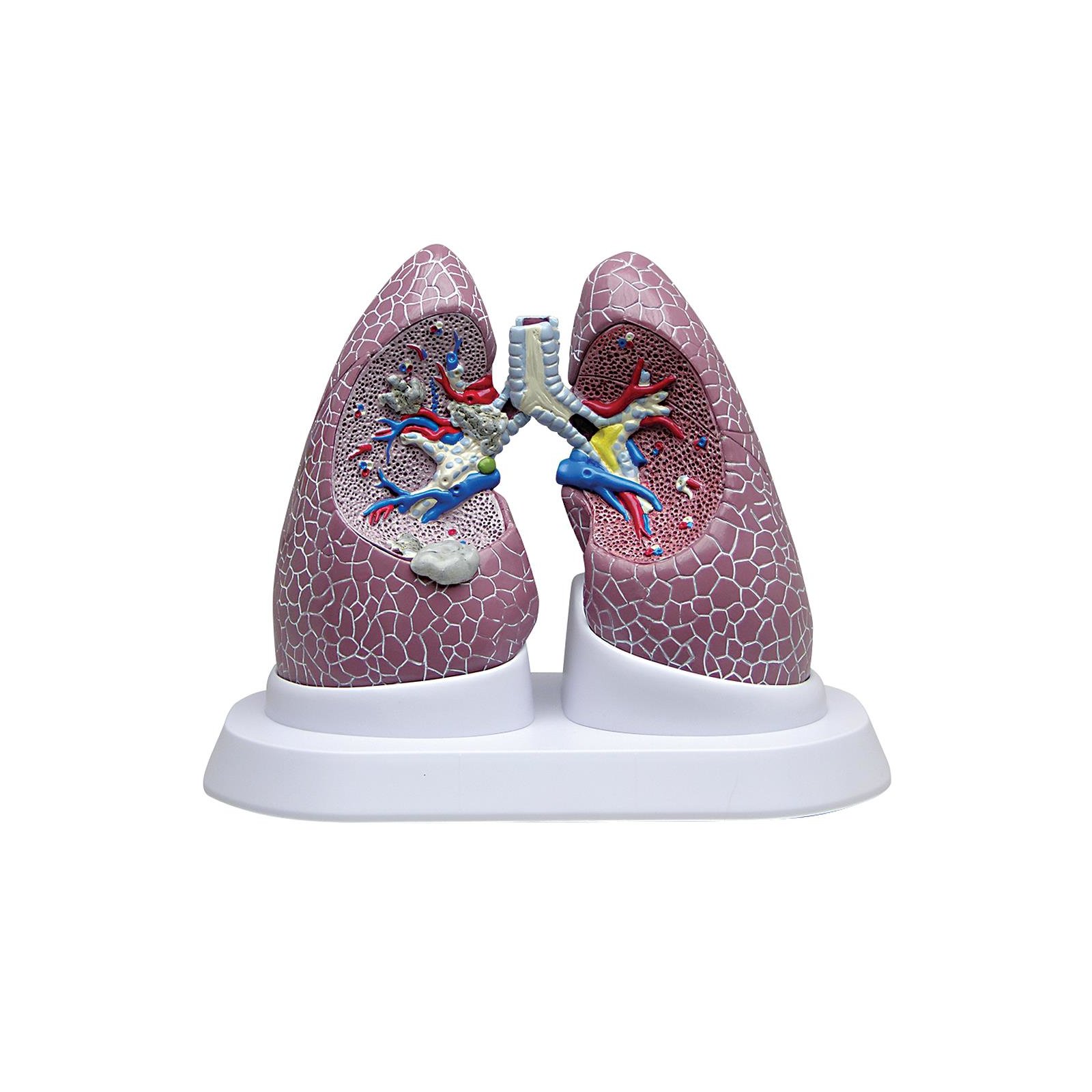 Lung Model Set with Pathologies GPI Anatomicals 3110 1018749