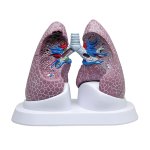 Lungen-Modell Set mit Pathologien