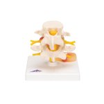 Lumbar Spine Model with Prolapsed Intervertebral Disc -...