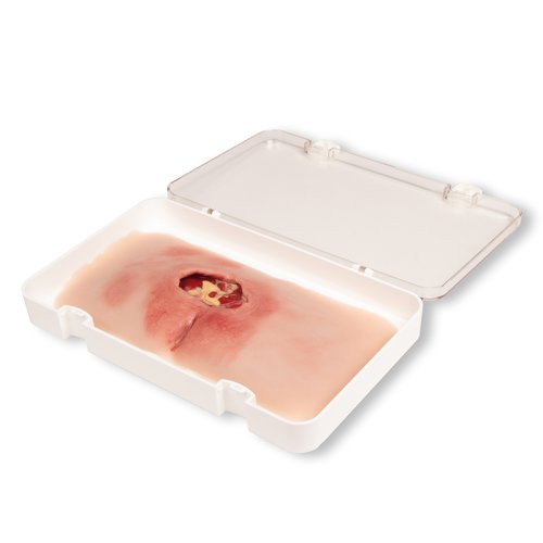 Wundmoulage sakraler Dekubitus, gesäubert