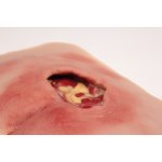 Wound moulage sacral decubitus, cleaned