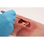 Wundmoulage sakraler Dekubitus, gesäubert