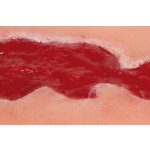 Wound moulage venous leg ulcer, small, granulation phase