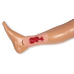 Wound moulage venous leg ulcer, small, granulation phase