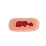 Wound moulage venous leg ulcer, small, granulation phase
