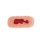 Wound moulage venous leg ulcer, small, granulation phase