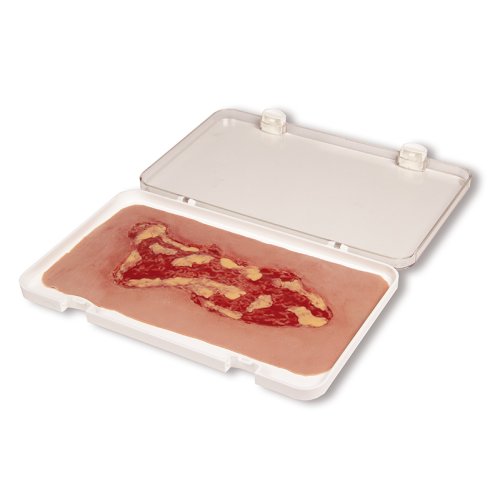 Wound moulage venous leg ulcer, large, exudation phase