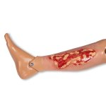 Wound moulage venous leg ulcer, large, exudation phase