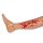 Wound moulage venous leg ulcer, large, exudation phase