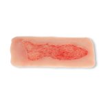 Wundmoulage Ulcus Cruris Venosum, groß, Epithelisierungsphase