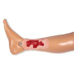 Wound moulage arterial leg ulcer, small, granulation phase