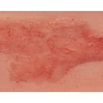 Wound moulage arterial leg ulcer, small, epithelization phase