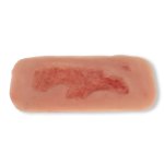 Wound moulage arterial leg ulcer, small, epithelization phase