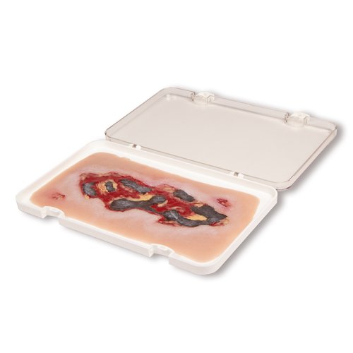 Wound moulage arterial leg ulcer, large, exudation phase