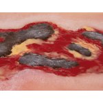 Wound moulage arterial leg ulcer, large, exudation phase