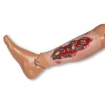 Wound moulage arterial leg ulcer, large, exudation phase