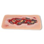 Wound moulage arterial leg ulcer, large, exudation phase