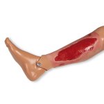 Wound moulage arterial leg ulcer, large, granulation phase