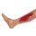 Wound moulage arterial leg ulcer, large, granulation phase