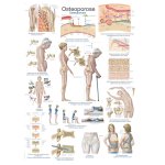 Chart Osteoporosis, 50x70cm