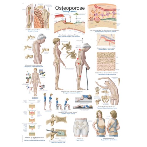 Chart Osteoporosis, 70x100cm