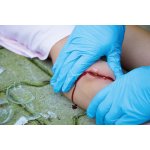Wundmoulage Schnittwunde mit Glassplitter