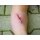 Wundmoulage Schnittwunde mit Glassplitter