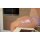 Wound moulage scalding