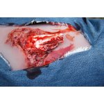 Wound moulage open fracture, leg with bleeding function