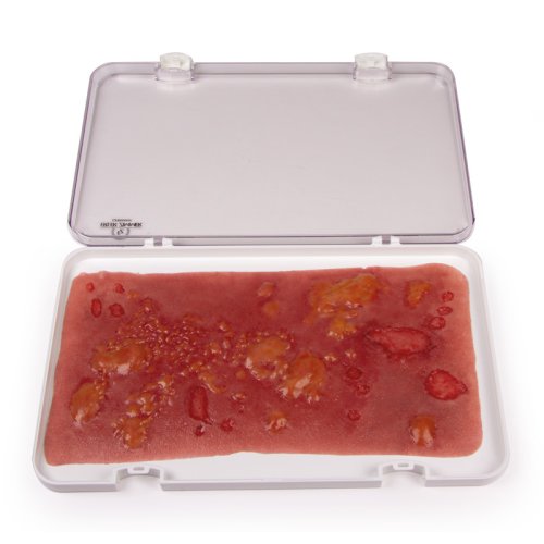 Wundmoulage Verbrennung 2. Grades