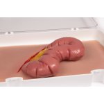Wound moulage protrusion of large intestines