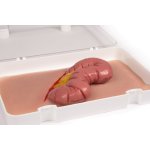 Wound moulage protrusion of large intestines