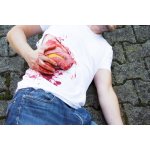 Wound moulage protrusion of large intestines