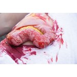 Wound moulage protrusion of large intestines