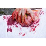 Wound moulage protrusion of large intestines