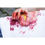 Wound moulage protrusion of large intestines