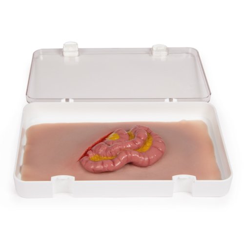 Wundmoulage Dünndarmaustritt