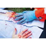 Wundmoulage Dünndarmaustritt