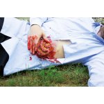 Wundmoulage Dünndarmaustritt
