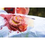 Wundmoulage Dünndarmaustritt
