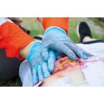 Wundmoulage Dünndarmaustritt