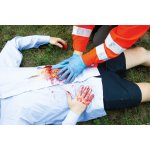 Wundmoulage Dünndarmaustritt