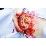 Wundmoulage Dünndarmaustritt