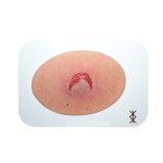 Stick-On Medium Offene Ablederung (Skin tears)