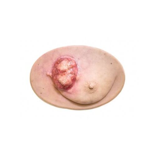 Stick-On Medium Ulcerierendes Mamma-CA (Brusttumor)
