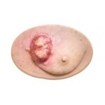 Stick-On Medium Ulcerierendes Mamma-CA (Brusttumor)