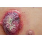 Stick-On Medium Ulcerierendes Mamma-CA (Brusttumor)