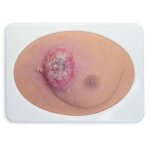 Stick-On Medium Ulcerierendes Mamma-CA (Brusttumor)